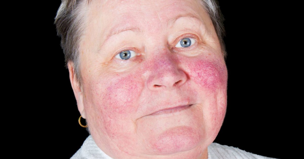 Malar Rash: Causes, Symptoms, Treatment, Picture, and More